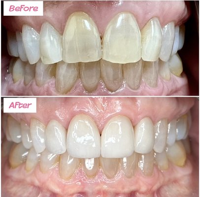 Veneers - Anterior crowns Veneers - Anterior crowns
