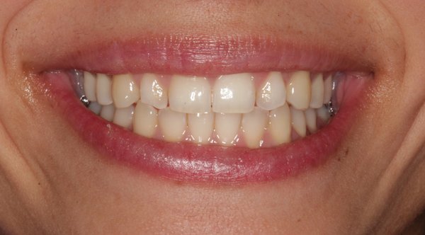 Smile Makeover using veneers - Patient was unhappy with the color and shapes of her teeth. We brightened her smile with the use of 12 porcelain veneers Smile Makeover using veneers - Patient was unhappy with the color and shapes of her teeth. We brightened her smile with the use of 12 porcelain veneers