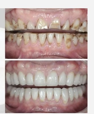 Restoration of severely worn teeth - Both these patients had severe tooth wear which was restored with beautiful porcelain veneers made by a master ceramist Restoration of severely worn teeth - Both these patients had severe tooth wear which was restored with beautiful porcelain veneers made by a master ceramist