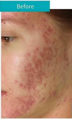 Acne Treatment - This was an acne treatment that one of our patients had done. She left feeling ecstatic and is happy with her new look. Acne Treatment - This was an acne treatment that one of our patients had done. She left feeling ecstatic and is happy with her new look.