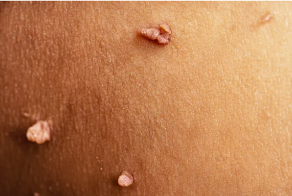 Skin tag - Skin tag removal Skin tag - Skin tag removal