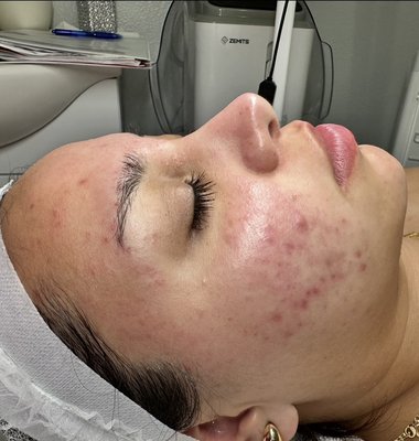 Acne biweekly bootcamp results - ✨ Bi-Weekly Acne Bootcamp ✨
Combination Acne • Type 4
Wow! Just look at this transformation 😍👇
In the before photo, you can see inflamed papules and pustules nodules and blackheads from active breakouts. Through consistency, clinical-grade treatments, and a customized home-care lifestyle routine, our acne patient has made such incredible transformation in 8 months 💎
Our Bi-Weekly Acne Bootcamp is designed for stubborn and combination acne cases like this one. With each visit, we target inflammation, clear out congestion, and repair the skin barrier while tackling post-inflammatory hyperpigmentation.
💖 The after photo shows:
✔ Reduced redness & inflammation
✔ Fewer active breakouts
✔ Smoother skin texture
✔ Healing & glow restored
📆 Bi-weekly sessions + tailored home care = long-term clear skin results.
If you’re struggling with acne (mild to severe), you don’t have to go through it alone! We create a step-by-step clinical plan to get your skin back on track—without the guesswork.
✨ Ready for your transformation? Book your Acne Bootcamp today and let’s get your glow on!
📲 Text or book online: 951-760-2340
Https://glowaestheticslnskincaretherapy.net
#AcneBootcamp #GlowAesthetics #ClinicalSkincare #ClearSkinJourney #AcneSpecialist #TemeculaSkin Acne biweekly bootcamp results - ✨ Bi-Weekly Acne Bootcamp ✨
Combination Acne • Type 4
Wow! Just look at this transformation 😍👇
In the before photo, you can see inflamed papules and pustules nodules and blackheads from active breakouts. Through consistency, clinical-grade treatments, and a customized home-care lifestyle routine, our acne patient has made such incredible transformation in 8 months 💎
Our Bi-Weekly Acne Bootcamp is designed for stubborn and combination acne cases like this one. With each visit, we target inflammation, clear out congestion, and repair the skin barrier while tackling post-inflammatory hyperpigmentation.
💖 The after photo shows:
✔ Reduced redness & inflammation
✔ Fewer active breakouts
✔ Smoother skin texture
✔ Healing & glow restored
📆 Bi-weekly sessions + tailored home care = long-term clear skin results.
If you’re struggling with acne (mild to severe), you don’t have to go through it alone! We create a step-by-step clinical plan to get your skin back on track—without the guesswork.
✨ Ready for your transformation? Book your Acne Bootcamp today and let’s get your glow on!
📲 Text or book online: 951-760-2340
Https://glowaestheticslnskincaretherapy.net
#AcneBootcamp #GlowAesthetics #ClinicalSkincare #ClearSkinJourney #AcneSpecialist #TemeculaSkin