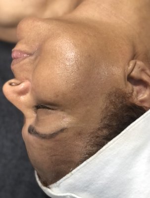 Dermaplane - Dermaplane face treatments before and immediately after session