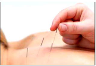 Dr. Lisa Vitale, DAC Acupuncture - Acupuncture is one of the oldest, most commonly used forms of medicine in the world. Originating in China more than 2,500 years ago, acupuncture is currently one of the most thoroughly researched, practiced, and respected forms of complementary medicine available anywhere.

According to Traditional Chinese Medicine, your overall health is determined by the quality of the Qi (energy) flow through the natural pathways of your body (meridians). A variety of techniques are used, including placing very thin sterile needles into specific points on the body, to stimulate and improve your Qi flow. The many benefits of acupuncture include: