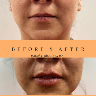 Before and after shots of lip fillers - Two perspectives- after administration of lip fillers. 
Schedule a consultation to determine if you are good candidate for fillers or botox!