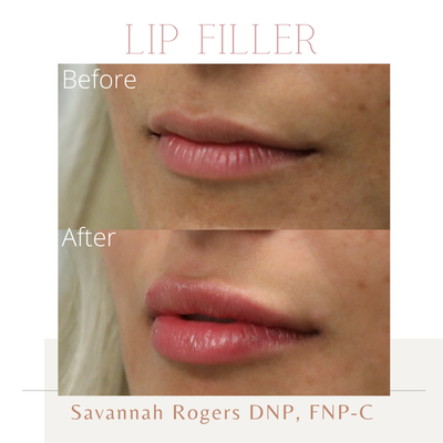 Lip filler - Adding filler to the lips can hydrate and plump the lips. Looking for something more subtle or significantly fuller we have different types of filler and amounts. I am confident we have the right treatment for you.