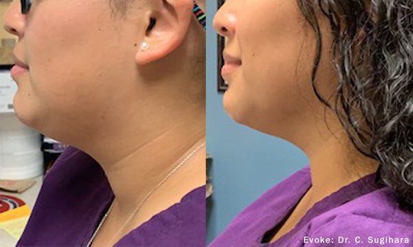 Evoke Facial/Jawline Slimming - Unlock Your Best Self with Evoke Facial Remodeling! Say Hello to Younger-Looking Skin, Improved Confidence, and Long-Lasting Results. Evoke is a revolutionary, hands-free facial remodeling platform. This proprietary non-invasive technology is an industry first, delivering hands-free thermal facial and submental remodeling. The remodeling of these areas produces results that are associated with a youthful appearance. Treat your lower face and jawline with no pain, downtime or swelling. Evoke Facial/Jawline Slimming - Unlock Your Best Self with Evoke Facial Remodeling! Say Hello to Younger-Looking Skin, Improved Confidence, and Long-Lasting Results. Evoke is a revolutionary, hands-free facial remodeling platform. This proprietary non-invasive technology is an industry first, delivering hands-free thermal facial and submental remodeling. The remodeling of these areas produces results that are associated with a youthful appearance. Treat your lower face and jawline with no pain, downtime or swelling.