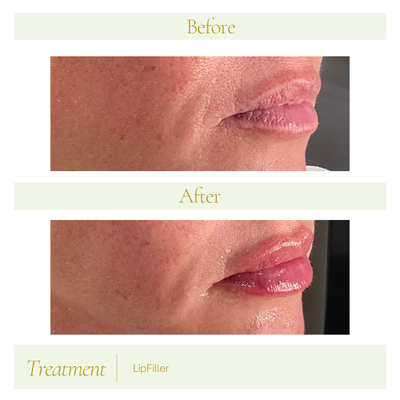 Beautiful Plump Lips - October Offer

$100 Off Lip Filler