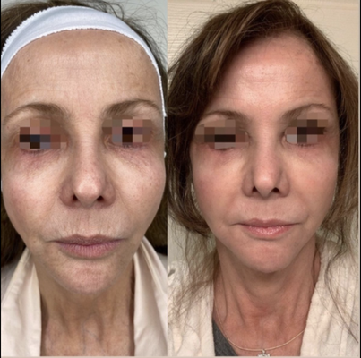 Opus Plasma - Opus Plasma is the first fractional plasma technology to enter the skin resurfacing category to address superficial to complex textural and skin quality concerns. It is customizable and can be controlled based on your desired result. This device offers ablative results with non-ablative downtim. Opus Plasma - Opus Plasma is the first fractional plasma technology to enter the skin resurfacing category to address superficial to complex textural and skin quality concerns. It is customizable and can be controlled based on your desired result. This device offers ablative results with non-ablative downtim.