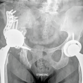 Revision Hip or Knee Replacement - Total Hip and Knee Replacements are an extremely successful procedure and allows many people to continue living an active lifestyle. However, on rare occasion a total hip replacement may fail for several reasons. Should your total hip or knee fail, your physician may recommend that you have another operation to remove and exchange some or all of the components. While the goal of a revision total hip replacement is to improve function and pain, a revision surgery is can be significantly different than a primary total knee or hip replacement as it is often a longer, more complex procedure. It may require extensive planning and the use of specialized equipment. A revision total hip or knee may require more extensive preparation. Your previous medical charts will need to be reviewed. You will need to obtain an x-ray. Occasionally more advanced imaging such as a CT or MRI may be required. Often laboratory tests will need to be obtained to determine if there is an infection or a reaction to metal components in your hip. Revision Hip or Knee Replacement - Total Hip and Knee Replacements are an extremely successful procedure and allows many people to continue living an active lifestyle. However, on rare occasion a total hip replacement may fail for several reasons. Should your total hip or knee fail, your physician may recommend that you have another operation to remove and exchange some or all of the components. While the goal of a revision total hip replacement is to improve function and pain, a revision surgery is can be significantly different than a primary total knee or hip replacement as it is often a longer, more complex procedure. It may require extensive planning and the use of specialized equipment. A revision total hip or knee may require more extensive preparation. Your previous medical charts will need to be reviewed. You will need to obtain an x-ray. Occasionally more advanced imaging such as a CT or MRI may be required. Often laboratory tests will need to be obtained to determine if there is an infection or a reaction to metal components in your hip.