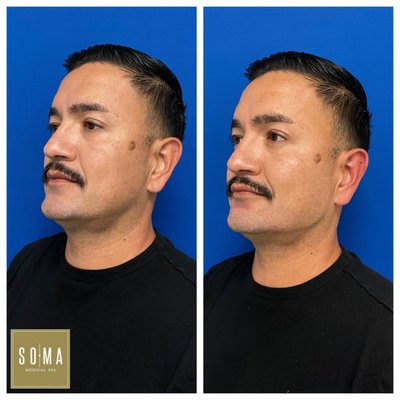 Jaw Filler - for sculpted jawline - Sculpt your Jawline with Volux. Jaw Filler - for sculpted jawline - Sculpt your Jawline with Volux.