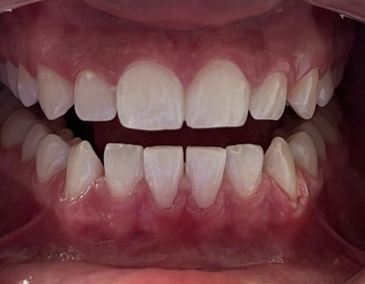 Teeth Whitening - First teeth whitening ever for this client. Shade change in one hour left her memorized! 
Whitening complete during a break and she went right back to work!!
3 session of 15 minutes, one hour and done!