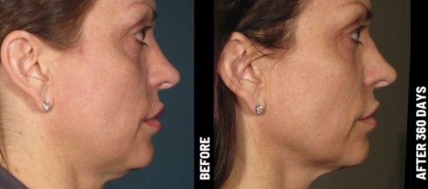 Ultherapy Prime Laser Treatment - Ultherapy Prime Laser Treatment Ultherapy Prime Laser Treatment - Ultherapy Prime Laser Treatment