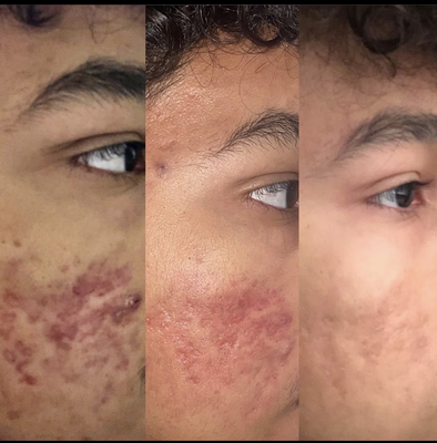 Acne treatments - a variety of acne treatment available. Especially design to help you, achieve looking radiant skin. Acne treatments - a variety of acne treatment available. Especially design to help you, achieve looking radiant skin.
