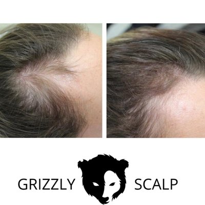 Women's SMP Most Natural Looking Results - GRIZZLY SCALP METHOD - At Grizzly Scalp, we are committed to delivering the most natural SMP results, helping you restore your confidence and feel like the best version of yourself again.
✔ Natural-looking results
✔ Non-invasive procedure
✔ Instant confidence boost
Check out some of our before & after transformations below.
BOOK YOUR FREE CONSULTATION TODAY! (619) 606-0102! Women's SMP Most Natural Looking Results - GRIZZLY SCALP METHOD - At Grizzly Scalp, we are committed to delivering the most natural SMP results, helping you restore your confidence and feel like the best version of yourself again.
✔ Natural-looking results
✔ Non-invasive procedure
✔ Instant confidence boost
Check out some of our before & after transformations below.
BOOK YOUR FREE CONSULTATION TODAY! (619) 606-0102!