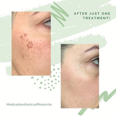 Icon IPL Photofacial - The ICON IPL Photofacial is a non-invasive treatment designed to rejuvenate the skin by addressing a variety of skin concerns, including sun damage, age spots, rosacea, and uneven skin tone. Using advanced intense Pulse Light (IPL) technology, the ICON device delivers precise pulses of light energy to target pigmented and vascular irregularities beneath the skin's surface. This process stimulates collagen production, improving skin texture and elasticity while reducing the appearance of tine lines and pores. The treatment is gentle with minimal downtime, making it an ideal solution for achieving a clearer, more youthful complexion. The ICON IPL Photofacial offers noticeable results after just a few sessions, with gradual improvements in skin tone and radiance over time. Icon IPL Photofacial - The ICON IPL Photofacial is a non-invasive treatment designed to rejuvenate the skin by addressing a variety of skin concerns, including sun damage, age spots, rosacea, and uneven skin tone. Using advanced intense Pulse Light (IPL) technology, the ICON device delivers precise pulses of light energy to target pigmented and vascular irregularities beneath the skin's surface. This process stimulates collagen production, improving skin texture and elasticity while reducing the appearance of tine lines and pores. The treatment is gentle with minimal downtime, making it an ideal solution for achieving a clearer, more youthful complexion. The ICON IPL Photofacial offers noticeable results after just a few sessions, with gradual improvements in skin tone and radiance over time.