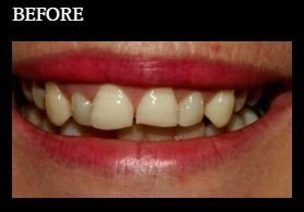 Veneers - Six misaligned teeth treated with cosmetic veneers.