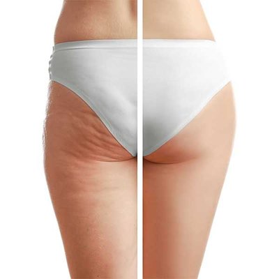 QWO Cellulite Treatment - There is a revolutionary new treatment called QWO Cellulite Treatment at Modesto Aesthetics and Laser. QWO is the first FDA approved injectable for the buttocks that is injected into the skin dimples and breaks down the fibroid bands that cause cellulite. Cellulite is not fat. Cellulite is not caused by what or how much you eat or because you are not exercising enough.
The enzymes in QWO—called collagenases are believed to target a structural cause under the skin. It’s thought that QWO works in 3 ways: releasing fibrous bands, redistributing fat cells, and stimulating the growth of new collagen.
QWO is injected directly into the skin dimples responsible for cellulite. Previously, when surgery was the only method to completely remove cellulite, the medical professional cut the fibrous band that trapped the fat. During the QWO treatment the injection contains an enzyme that dissolves the fibrous bands. QWO is a first of its kind treatment. Administering practitioners have reported that there is slight bruising and soreness and a minimal amount of downtime. Patients will see skin tightening and cellulite reduction 28 days (about 4 weeks) after the final treatment. The complete three treatments are administered 21-days-apart. Results will last 2-3 years. Results may last 2-3 years with proper diet and exercise. Individual results may vary, and some patients may need additional treatment for their desired outcome.
Modesto Aesthetics and Laser is proud to offer the QWO treatment injections. At Modesto Aesthetics and Laser, they love for their clients to “experience the art of beauty with the science of skin care.” Their clinic is staffed with highly qualified and trained medical professionals. They take pride in giving the highest level of service and results. From head-to-toe Modesto Aesthetics and Laser has you covered. Call at (209) 577-3340 to schedule a consultation. QWO Cellulite Treatment - There is a revolutionary new treatment called QWO Cellulite Treatment at Modesto Aesthetics and Laser. QWO is the first FDA approved injectable for the buttocks that is injected into the skin dimples and breaks down the fibroid bands that cause cellulite. Cellulite is not fat. Cellulite is not caused by what or how much you eat or because you are not exercising enough.
The enzymes in QWO—called collagenases are believed to target a structural cause under the skin. It’s thought that QWO works in 3 ways: releasing fibrous bands, redistributing fat cells, and stimulating the growth of new collagen.
QWO is injected directly into the skin dimples responsible for cellulite. Previously, when surgery was the only method to completely remove cellulite, the medical professional cut the fibrous band that trapped the fat. During the QWO treatment the injection contains an enzyme that dissolves the fibrous bands. QWO is a first of its kind treatment. Administering practitioners have reported that there is slight bruising and soreness and a minimal amount of downtime. Patients will see skin tightening and cellulite reduction 28 days (about 4 weeks) after the final treatment. The complete three treatments are administered 21-days-apart. Results will last 2-3 years. Results may last 2-3 years with proper diet and exercise. Individual results may vary, and some patients may need additional treatment for their desired outcome.
Modesto Aesthetics and Laser is proud to offer the QWO treatment injections. At Modesto Aesthetics and Laser, they love for their clients to “experience the art of beauty with the science of skin care.” Their clinic is staffed with highly qualified and trained medical professionals. They take pride in giving the highest level of service and results. From head-to-toe Modesto Aesthetics and Laser has you covered. Call at (209) 577-3340 to schedule a consultation.