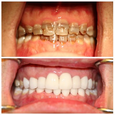 Smile Transformation with Porcelain Crowns - These patients had Amazing Smile Transformation with porcelain crowns done on their teeth to improve their smile. Smile Transformation with Porcelain Crowns - These patients had Amazing Smile Transformation with porcelain crowns done on their teeth to improve their smile.