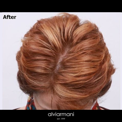 Female Hair Restoration - eported Areas of Concern:
This patient experienced hair loss in zone 1(temples) and zone 2 (hair line). By the age of 40, nearly 50% of all women will experience hair thinning to some extent. This is due to a number of factors, including genetics, hormonal changes, and some medical conditions.
Alvi Armani Recommendations and Treatment Plan:
We recommended a hair restoration procedure to implant 1,800 grafts in zone 1(temples) and zone 2 (hair line). PRP(Platelet Rich Plasma) therapy was also recommended to support her hair restoration goals.
Post Procedure Evaluation:
The patient received the 1,800 grafts in zone 1(temples) and zone 2 (hair line) in addition to PRP to speed her healing. The combination of FUE, and PRP therapy has made the patient’s hair appear fuller, and healthier than before. After healing, the transplanted hair can be treated just like any other hair, and can be dyed and cut to your preference. Female Hair Restoration - eported Areas of Concern:
This patient experienced hair loss in zone 1(temples) and zone 2 (hair line). By the age of 40, nearly 50% of all women will experience hair thinning to some extent. This is due to a number of factors, including genetics, hormonal changes, and some medical conditions.
Alvi Armani Recommendations and Treatment Plan:
We recommended a hair restoration procedure to implant 1,800 grafts in zone 1(temples) and zone 2 (hair line). PRP(Platelet Rich Plasma) therapy was also recommended to support her hair restoration goals.
Post Procedure Evaluation:
The patient received the 1,800 grafts in zone 1(temples) and zone 2 (hair line) in addition to PRP to speed her healing. The combination of FUE, and PRP therapy has made the patient’s hair appear fuller, and healthier than before. After healing, the transplanted hair can be treated just like any other hair, and can be dyed and cut to your preference.