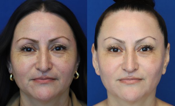 Photofacial (IPL) - Photofacial is a laser light treatment that targets pigment issues, such as brown spots, sun damage and red spots, and Rosacea