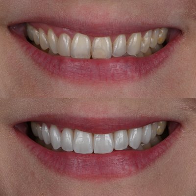 Veneers - New veneers to enhance a patient's smile.
