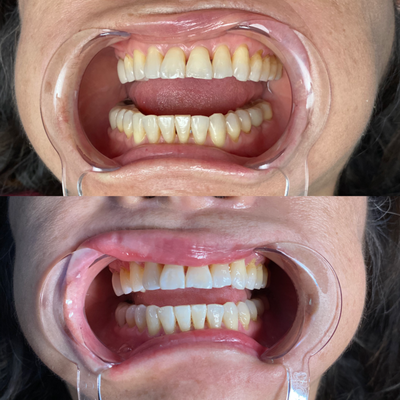 Teeth Whitening - Teeth Whitening services Available for guests 16 years and older 
Whitening will not work on caps, veneers, crowns or fillings. It also won’t be effective if your tooth discoloration is caused by medications or a tooth injury.