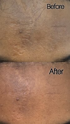 Before and After Photos - Real Clients. Real Results.
Explore before & after photos from treatments performed at Essence by Shine. Every treatment is customized to each client’s unique concerns, goals, and natural features.
From skin rejuvenation and chemical peels to microneedling, injectables, and other aesthetic treatments, my goal is always to enhance, not change what makes you uniquely you.
Results vary from person to person. Consultations are available to help determine the best treatment plan for you. Before and After Photos - Real Clients. Real Results.
Explore before & after photos from treatments performed at Essence by Shine. Every treatment is customized to each client’s unique concerns, goals, and natural features.
From skin rejuvenation and chemical peels to microneedling, injectables, and other aesthetic treatments, my goal is always to enhance, not change what makes you uniquely you.
Results vary from person to person. Consultations are available to help determine the best treatment plan for you.