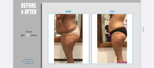 “Fat Reduction & Body Contouring” - In just 10 Endospheres sessions, our client achieved visible fat reduction, smoother skin, and a dramatic decrease in cellulite. The treatment sculpted her body, improved tone, and boosted confidence — all without surgery.