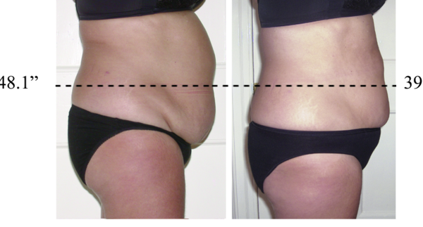 CryoSkin Revolution Slimming and Toning - This model had 10 Cryo Slimming and toning sessions CryoSkin Revolution Slimming and Toning - This model had 10 Cryo Slimming and toning sessions