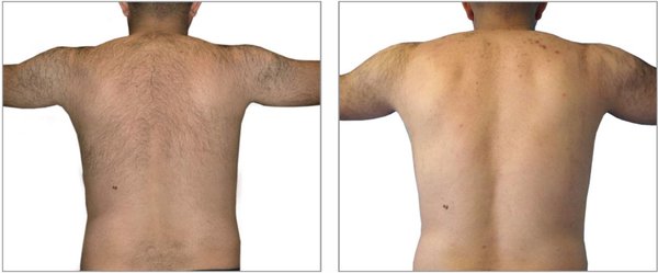 Laser Hair Removal - Laser Hair Removal is a process of treatment, not a one time treatment. Once completed the treatment, your Practioner can tell you about the follow up treatment after a year. Laser Hair Removal - Laser Hair Removal is a process of treatment, not a one time treatment. Once completed the treatment, your Practioner can tell you about the follow up treatment after a year.