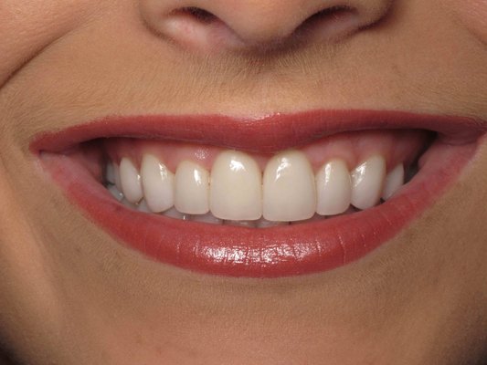 smile Transformations - Image 1 (Before):
Our patient wanted a forever smile that she will feel confident in and stated that the natural charm of their smile was hindered.
Image 2 (After):
The "After" photo exhibits the remarkable transformation achieved by Mercier Dental. The patient's smile now radiates with newfound confidence and brilliance. Dental crowns have been expertly placed, covering previously damaged teeth and restoring their natural shape and color. The teeth appear beautifully aligned, creating a harmonious and stunning smile.
🌐 To learn more about our smile transformation services, visit www.mercierdental.com or call (662)534-5252 to schedule a consultation today. smile Transformations - Image 1 (Before):
Our patient wanted a forever smile that she will feel confident in and stated that the natural charm of their smile was hindered.
Image 2 (After):
The "After" photo exhibits the remarkable transformation achieved by Mercier Dental. The patient's smile now radiates with newfound confidence and brilliance. Dental crowns have been expertly placed, covering previously damaged teeth and restoring their natural shape and color. The teeth appear beautifully aligned, creating a harmonious and stunning smile.
🌐 To learn more about our smile transformation services, visit www.mercierdental.com or call (662)534-5252 to schedule a consultation today.
