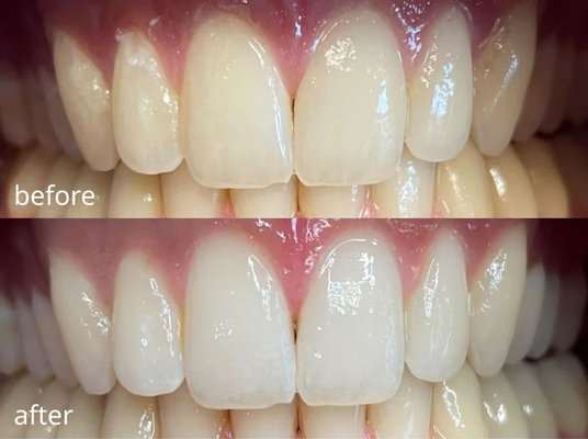 Professional Teeth Whitening - See the stunning transformation! ✨ Our professional teeth whitening treatment brightened this patient's smile, removing stains for a whiter, more confident look. Ready for your own smile upgrade? Book your appointment today! 😁 #TeethWhitening #BrighterSmile Professional Teeth Whitening - See the stunning transformation! ✨ Our professional teeth whitening treatment brightened this patient's smile, removing stains for a whiter, more confident look. Ready for your own smile upgrade? Book your appointment today! 😁 #TeethWhitening #BrighterSmile