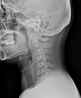 Posture Correction (X-rays Before and After) - These are before and after x-rays of one of our patients. On the left (picture 1), you will see that the patient's neck does not have a normal curve or posture. The neck curve is reversed in the wrong direction which is usually due to prolonged bad posture on computers and cell phones. On the right (picture 2), you will see that the curve has almost been restored to normal. With a little more time and effort, this patient's neck curve will be completely normal. With proper chiropractic maintenance as well as good posture and habits at the computer and on cell phones, they will be be able to maintain these great results. Posture Correction (X-rays Before and After) - These are before and after x-rays of one of our patients. On the left (picture 1), you will see that the patient's neck does not have a normal curve or posture. The neck curve is reversed in the wrong direction which is usually due to prolonged bad posture on computers and cell phones. On the right (picture 2), you will see that the curve has almost been restored to normal. With a little more time and effort, this patient's neck curve will be completely normal. With proper chiropractic maintenance as well as good posture and habits at the computer and on cell phones, they will be be able to maintain these great results.