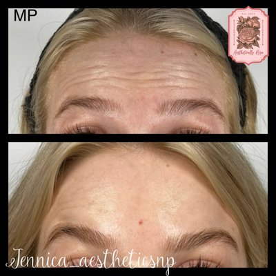 Botox/Dysport - Botox and dysport Botox/Dysport - Botox and dysport