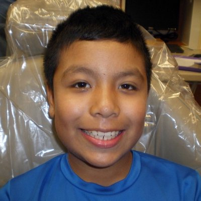 HealthyStart® Pediatric Treatment Case - This pediatric case shows a completed HealthyStart® treatment. Before treatment, the patient's parent reported concerns including snoring, difficulty breathing at night, restless sleep, headaches, sleep talking, and challenges at school. The patient was also receiving speech therapy at the time.

During and after treatment, the parent reported improvements in sleep and other concerns, while the dental photos show changes in tooth alignment and bite relationship.

HealthyStart® treatment is individualized based on each child's dental development and clinical needs. Results and experiences vary from patient to patient.