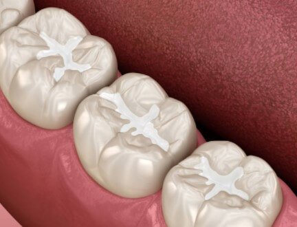 DENTAL SEALANTS - TOOTH SEALANT

Teeth in the back of your mouth have the deepest grooves and often incur more cavities.

The back teeth, which are known as molars, are quite different from your other teeth. The biting surfaces are designed to enable you to chew your food into pieces that are small enough to swallow. They are equipped with cuspids that meet in grooves.

For some people, these grooves and pits where the cuspids meet are very deep and difficult to clean. These areas are highly susceptible to tooth decay because food particles and harmful bacteria can become stuck and may be very difficult to remove. If food particles and bacteria are allowed to remain on a tooth for a long period, the tooth can develop a cavity and decay. For dental patients with deep grooves and pits, an application of dental sealants is a perfect solution.

QUESTIONS ABOUT SEALANTS?

Here are a few questions that dental patients sometimes have about dental sealants:

Do sealants wear away?

Even the highest quality dental sealants may eventually wear away. However, your dentist, Dr. Brazdo can reapply them as needed for continued dental protection.

Does the application of sealants hurt?

You should not experience any discomfort during the application of your dental sealants.

Do sealants negatively impact your health?

Dental sealants are made of plastic, so they may contain BPA. Still, dental sealants are considered quite safe. Any BPA content is well below the safety limits established by the Environmental Protection Agency (EPA).

MORE ABOUT SEALANTS

Dental sealants can be painted on both permanent and primary teeth, making them a cavity-preventing solution from which the whole family can benefit.

After a sealant is applied, the coated teeth are protected from decay caused by bacterial acids. In addition, the depth of the grooves of the chewing surfaces is reduced, so food and debris are less likely to settle there.

A sealant application for permanent teeth is important because the teeth will never be shed or replaced. However, sealants are also important for primary teeth.

Even though a primary tooth will eventually be replaced by a permanent tooth, the baby tooth serves as a placeholder for the permanent counterpart that will eventually erupt. If the primary tooth is lost too early due to decay, the permanent tooth may not present in proper alignment.

In addition, tooth decay can spread from a primary tooth to adjacent teeth and even to underlying permanent teeth. Thus, the proper protection of a primary tooth is important.

SHOULD I CONSIDER SEALANTS?

Do you have sensitivity in the biting surfaces of your teeth?

If your teeth experience discomfort while chewing or from changes in temperature, a dental sealant may help. Your tooth enamel contains pores that are sealed as resin sealants coat your teeth. Ask for dental advice about this anytime.

Do you find it difficult to brush the biting surfaces of your teeth?

Even if you brush meticulously, it can be difficult for the head of a toothbrush to reach the chewing surfaces of the molars at the very back of your mouth.

Do you avoid certain foods because you worry they will become lodged between your cuspids?
Restricting your diet because of a fear of food becoming stuck in your teeth can result in nutrient deficiencies.