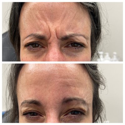 Botox/Dysport/Daxxify and Fillers - Be sure to ask about our expert Doctor injector, Dr. Courtney for all of your Botox, Dysport and Daxxify needs. We also offer Juvederm, Restylane and RHA fillers too! Call today to schedule your free consultation, 302-736-6334 Botox/Dysport/Daxxify and Fillers - Be sure to ask about our expert Doctor injector, Dr. Courtney for all of your Botox, Dysport and Daxxify needs. We also offer Juvederm, Restylane and RHA fillers too! Call today to schedule your free consultation, 302-736-6334