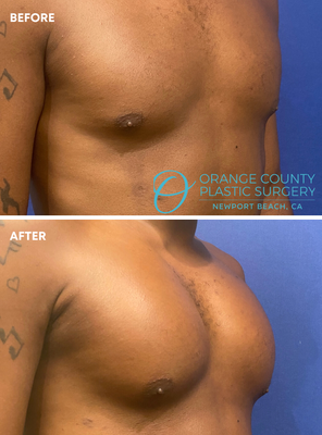 Pec Implants - Dr. Bunkis understands that achieving the chiseled look you desire through exercise alone is sometimes impossible. This is why Dr. Bunkis is thrilled to offer his male patients pec implants to finally acquire the look they’ve been longing for. The results can leave you with a stronger, more masculine chest contour.