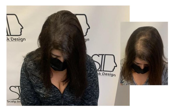 Female Hair Density - Fast and Affordable Hair Loss Solution
SMP is a painless treatment to conceal thinning hair, balding, and receding hairlines.

Causes for women’s hair loss include: medication side affects, alopecia, and simply aging. Currently, one of the most recommended hair loss solution is scalp micropigmentation for women.