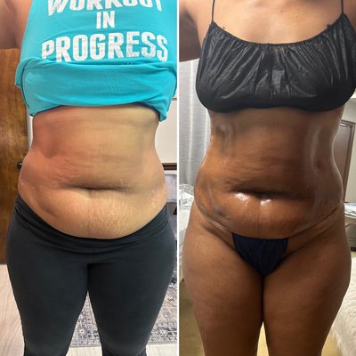 Body Sculpting - Body Sculpting - Non invasive, safe, painless, natural, lasting results. 360 Lipo Service includes Wood Therapy, Cavitation, Skin tightening and Lipo Pads. Clients 1st session. 38” waist to 36” waist…we lossed 2” inches in 2 hours!!! Body Sculpting - Body Sculpting - Non invasive, safe, painless, natural, lasting results. 360 Lipo Service includes Wood Therapy, Cavitation, Skin tightening and Lipo Pads. Clients 1st session. 38” waist to 36” waist…we lossed 2” inches in 2 hours!!!