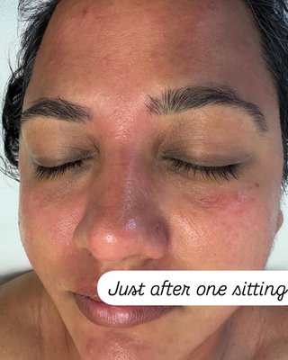 Carbon peel - Had a wonderful session with my client for her carbon peeling treatment! We focused on deep cleansing the pores, removing dead skin cells, and brightening the overall complexion. The results were amazing her skin looked instantly smoother, refreshed, and had a natural, healthy glow. She was so happy with the transformation and loved how soft and radiant her skin felt afterward. Always rewarding to see such beautiful results and happy smiles! ✨🖤 Carbon peel - Had a wonderful session with my client for her carbon peeling treatment! We focused on deep cleansing the pores, removing dead skin cells, and brightening the overall complexion. The results were amazing her skin looked instantly smoother, refreshed, and had a natural, healthy glow. She was so happy with the transformation and loved how soft and radiant her skin felt afterward. Always rewarding to see such beautiful results and happy smiles! ✨🖤