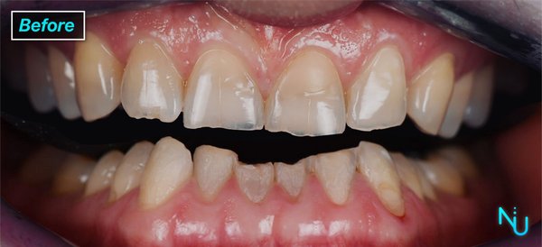 Veneers 2 - Before and After Images of Porcelain Veneers Placed at Nu Dentistry.