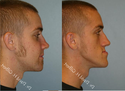 Corrective Jaw Surggery - This 19 year old gentleman developed a progressive under-bite or class 3 malocclusion. Correction required both orthodontics (braces) and corrective jaw surgery (orthognathic surgery). He was very please with the ability to eat, chew and speak properly, in addition to the cosmetic result.