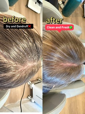Dry Scalp Moisturizing Scalp-Targeted Treatment - We will perform a deep cleansing of the scalp using carbonated spring water, followed by the use of instruments to remove dry dandruff, and the use of different instruments and corresponding products to moisturize the scalp and hair. Dry Scalp Moisturizing Scalp-Targeted Treatment - We will perform a deep cleansing of the scalp using carbonated spring water, followed by the use of instruments to remove dry dandruff, and the use of different instruments and corresponding products to moisturize the scalp and hair.