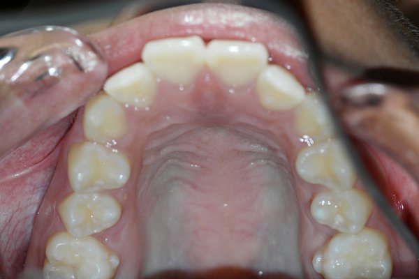 Ortho Treatment - Before and after photos of ortho case with moderate deep bite, mild to moderate crowding in both upper and lower arches and rotated anterior teeth. The upper arch also exhibited a slightly narrow, V-shaped form. The treatment plan involved the use of fixed orthodontic appliances to achieve alignment, reduce the deep bite, and correct rotations. Space was created through arch development and alignment mechanics, allowing for proper tooth positioning and improved arch form. Over the course of treatment, the overbite was successfully reduced to within the ideal range, and the dental arches were aligned. Rotations were corrected, crowding was resolved, and a balanced, esthetic smile was achieved. Ortho Treatment - Before and after photos of ortho case with moderate deep bite, mild to moderate crowding in both upper and lower arches and rotated anterior teeth. The upper arch also exhibited a slightly narrow, V-shaped form. The treatment plan involved the use of fixed orthodontic appliances to achieve alignment, reduce the deep bite, and correct rotations. Space was created through arch development and alignment mechanics, allowing for proper tooth positioning and improved arch form. Over the course of treatment, the overbite was successfully reduced to within the ideal range, and the dental arches were aligned. Rotations were corrected, crowding was resolved, and a balanced, esthetic smile was achieved.