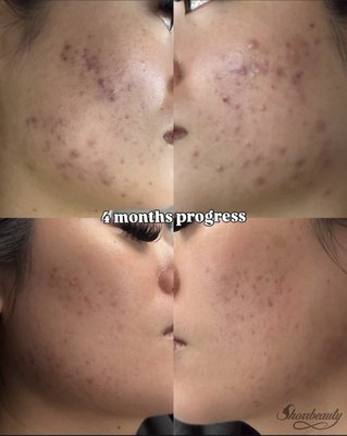 Before & Afters - Real client results focused on corrective, result-driven skincare. These before and afters showcase treatments targeting acne, acne scarring, pigmentation, and overall skin health. Every treatment plan is customized based on the client’s skin—using advanced treatments like microchanneling, chemical peels, and corrective skincare. No filters, no shortcuts—just consistent, real results and healthier skin over time. Before & Afters - Real client results focused on corrective, result-driven skincare. These before and afters showcase treatments targeting acne, acne scarring, pigmentation, and overall skin health. Every treatment plan is customized based on the client’s skin—using advanced treatments like microchanneling, chemical peels, and corrective skincare. No filters, no shortcuts—just consistent, real results and healthier skin over time.
