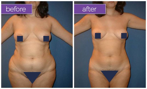 Mommy Makeover - Pregnancy and childbirth are times of tremendous joy, but they can significantly alter your fat distribution and overall body shape. The Belle Medical team specializes in forming customized treatment plans that help women get their bodies back after pregnancy. We’ll work closely with you to form a personalized plan for sculpting and reshaping your body back to its pre-pregnancy appearance. Take a look at our gallery of before and after Mommy Makeover pictures for an idea of how we can help you. Mommy Makeover - Pregnancy and childbirth are times of tremendous joy, but they can significantly alter your fat distribution and overall body shape. The Belle Medical team specializes in forming customized treatment plans that help women get their bodies back after pregnancy. We’ll work closely with you to form a personalized plan for sculpting and reshaping your body back to its pre-pregnancy appearance. Take a look at our gallery of before and after Mommy Makeover pictures for an idea of how we can help you.