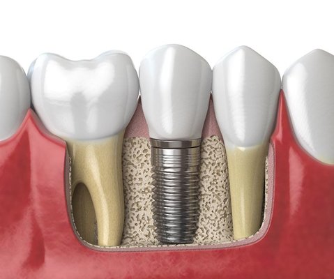 A Permanent Solution to Tooth Loss - When a tooth goes missing, the jawbone loses stimulation from the root. As a result, the body diverts those nutrients elsewhere in the body, leaving the jawbone weaker and less able to provide adequate support for the remaining teeth. Out of the options for replacing missing teeth, dental implants are the only choice that replaces the entire tooth structure, including the root. As such, it’s the only tooth replacement option that can prevent jawbone deterioration after tooth loss! At Archway Dental, Dr. Parmar is able to offer this treatment to give you back your smile’s confidence, strength, and beauty. Are you interested in knowing if you qualify for dental implants in McKinney, TX? Contact us today to schedule a consultation! A Permanent Solution to Tooth Loss - When a tooth goes missing, the jawbone loses stimulation from the root. As a result, the body diverts those nutrients elsewhere in the body, leaving the jawbone weaker and less able to provide adequate support for the remaining teeth. Out of the options for replacing missing teeth, dental implants are the only choice that replaces the entire tooth structure, including the root. As such, it’s the only tooth replacement option that can prevent jawbone deterioration after tooth loss! At Archway Dental, Dr. Parmar is able to offer this treatment to give you back your smile’s confidence, strength, and beauty. Are you interested in knowing if you qualify for dental implants in McKinney, TX? Contact us today to schedule a consultation!