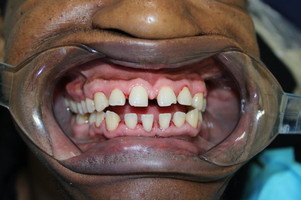 Deep Cleaning - Bleeding gums, bad breath, gum tenderness, or loose teeth may be signs of gum disease. At Polished Dental & Orthodontics, we provide gentle, thorough deep cleanings (scaling and root planing) to remove harmful plaque and tartar below the gumline, helping stop the progression of periodontal disease.
Our deep cleaning treatment can help:
Treat early to moderate gum disease
Reduce gum inflammation and bleeding
Eliminate bacteria below the gumline
Improve bad breath
Protect your teeth and bone from further damage
Promote healthier gums and a healthier smile Deep Cleaning - Bleeding gums, bad breath, gum tenderness, or loose teeth may be signs of gum disease. At Polished Dental & Orthodontics, we provide gentle, thorough deep cleanings (scaling and root planing) to remove harmful plaque and tartar below the gumline, helping stop the progression of periodontal disease.
Our deep cleaning treatment can help:
Treat early to moderate gum disease
Reduce gum inflammation and bleeding
Eliminate bacteria below the gumline
Improve bad breath
Protect your teeth and bone from further damage
Promote healthier gums and a healthier smile